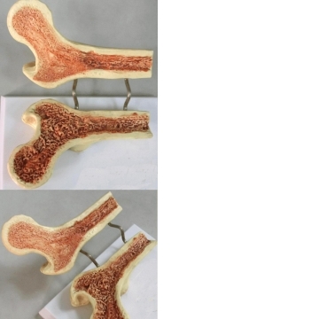 JP-502 成人股骨骨質疏鬆比較模型